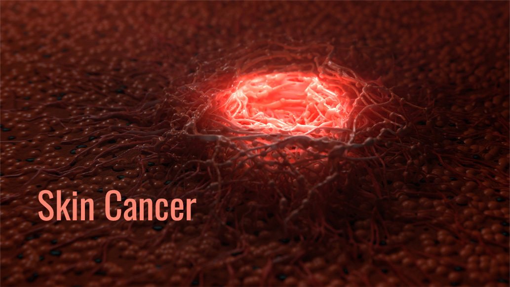 Skin Cancer